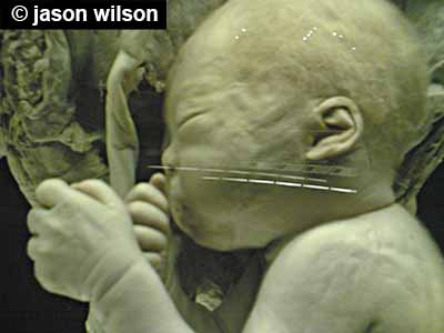 Foetus avec des plis au poignet