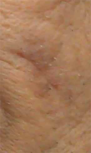Skin bruised by grooming activities