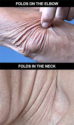 Cutaneous folds on the elbow and in the neck