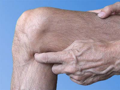 Cet arthrite n'est que des plis dans la peau du genou