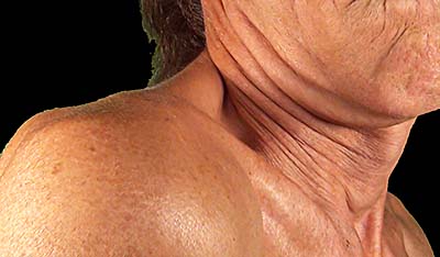 Folds in the neck/shoulder area
