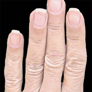 Stretched horizontal folds on fingers